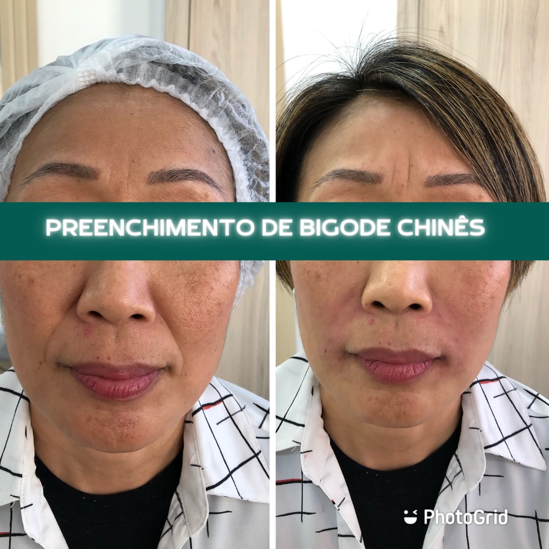 Antes e depois — Preenchimento — bigode chinês na Clínica Sensitivity, Osasco