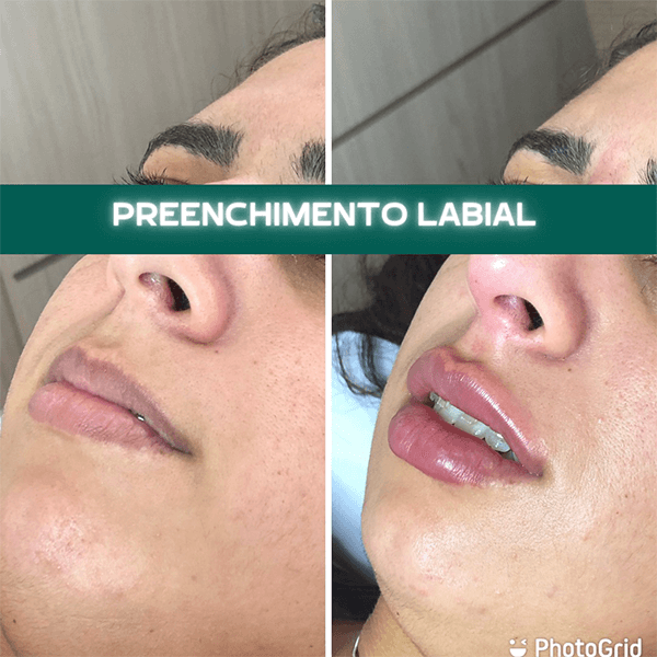 Antes e depois — Preenchimento labial na Clínica Sensitivity, Osasco