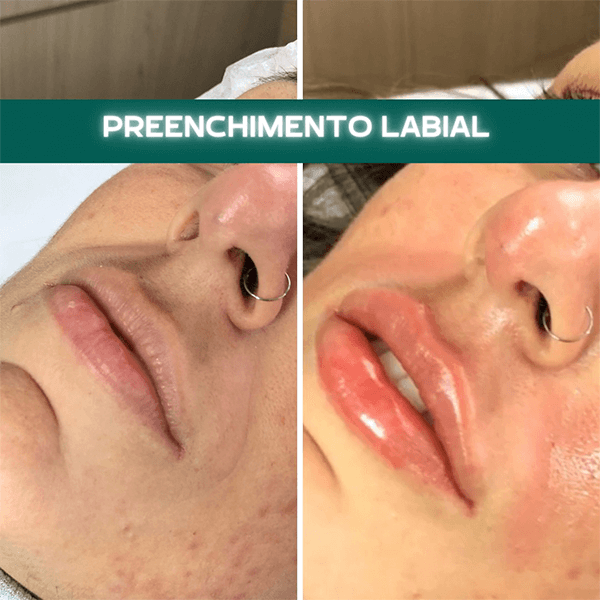 Antes e depois — Preenchimento labial na Clínica Sensitivity, Osasco