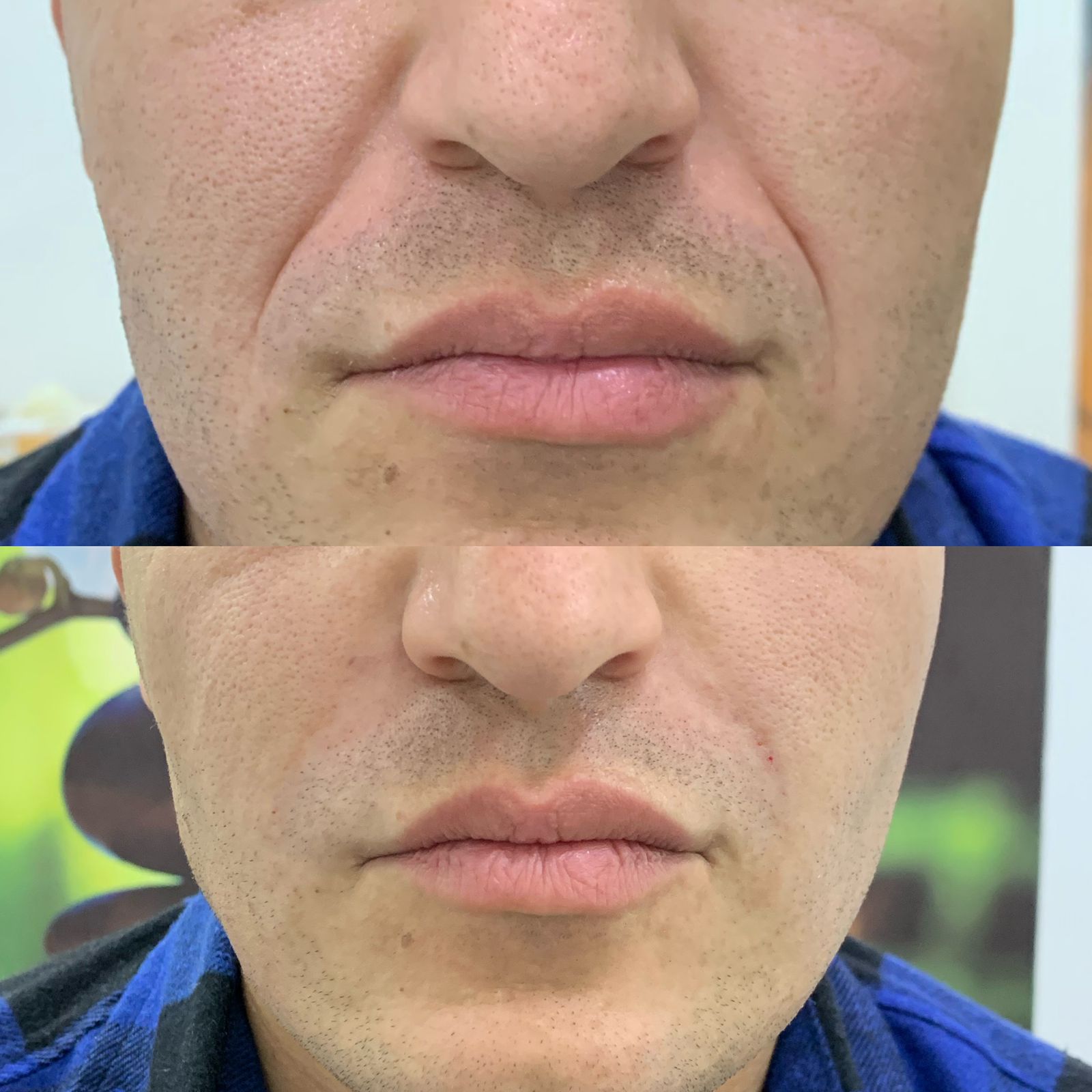 Antes e depois — Preenchimento — bigode chinês na Clínica Sensitivity, Osasco