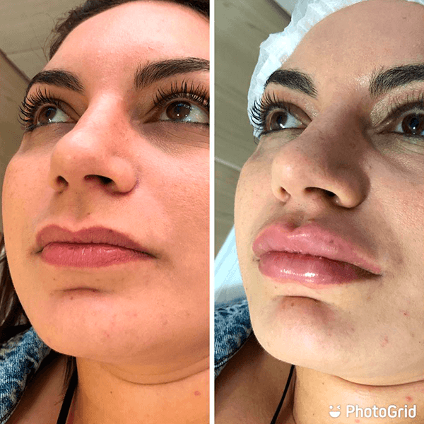 Antes e depois — Preenchimento labial na Clínica Sensitivity, Osasco