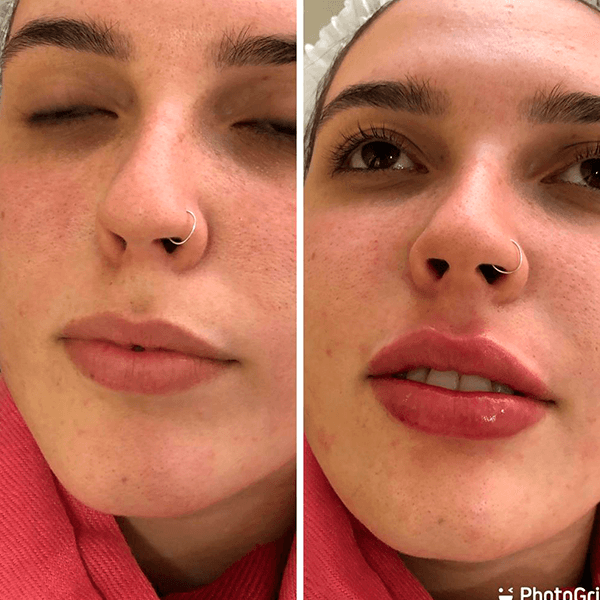 Antes e depois — Preenchimento labial na Clínica Sensitivity, Osasco