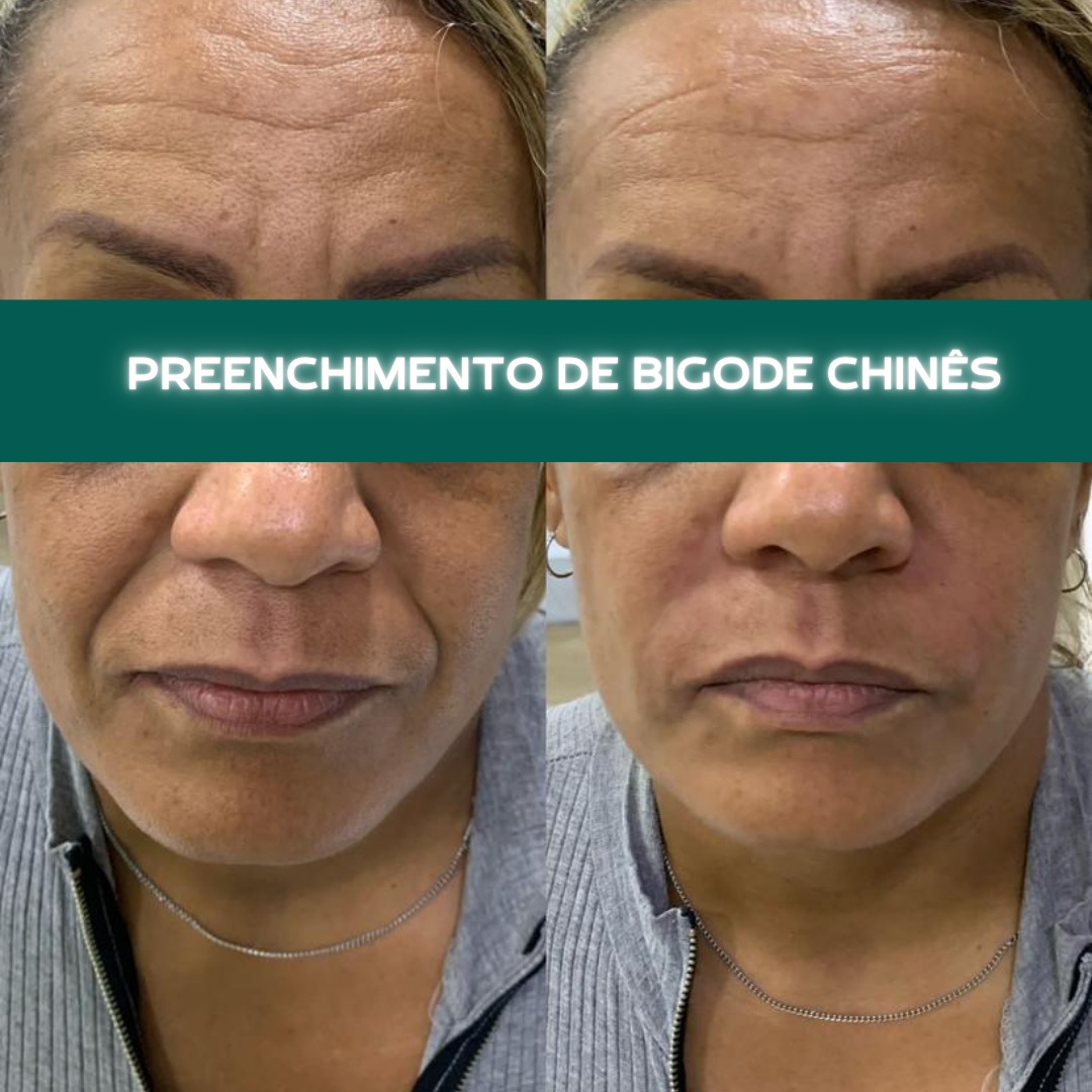 Antes e depois — Preenchimento — bigode chinês na Clínica Sensitivity, Osasco