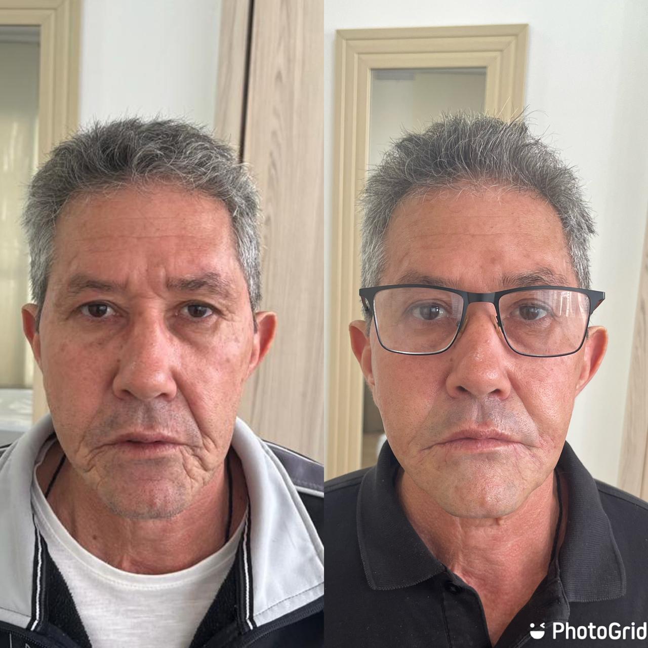 Antes e depois — Bioestimulador — colágeno na Clínica Sensitivity, Osasco
