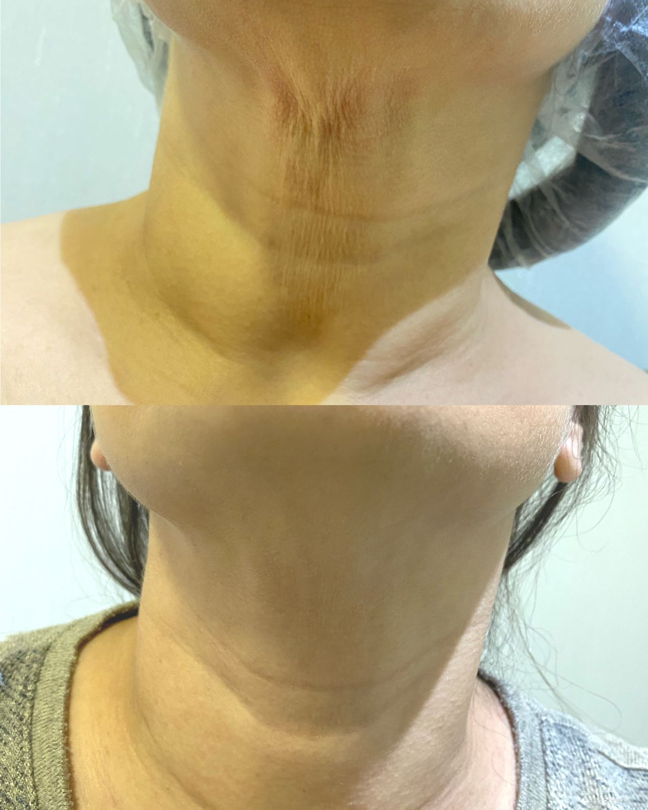 Antes e depois — Bioestimulador — pescoço na Clínica Sensitivity, Osasco