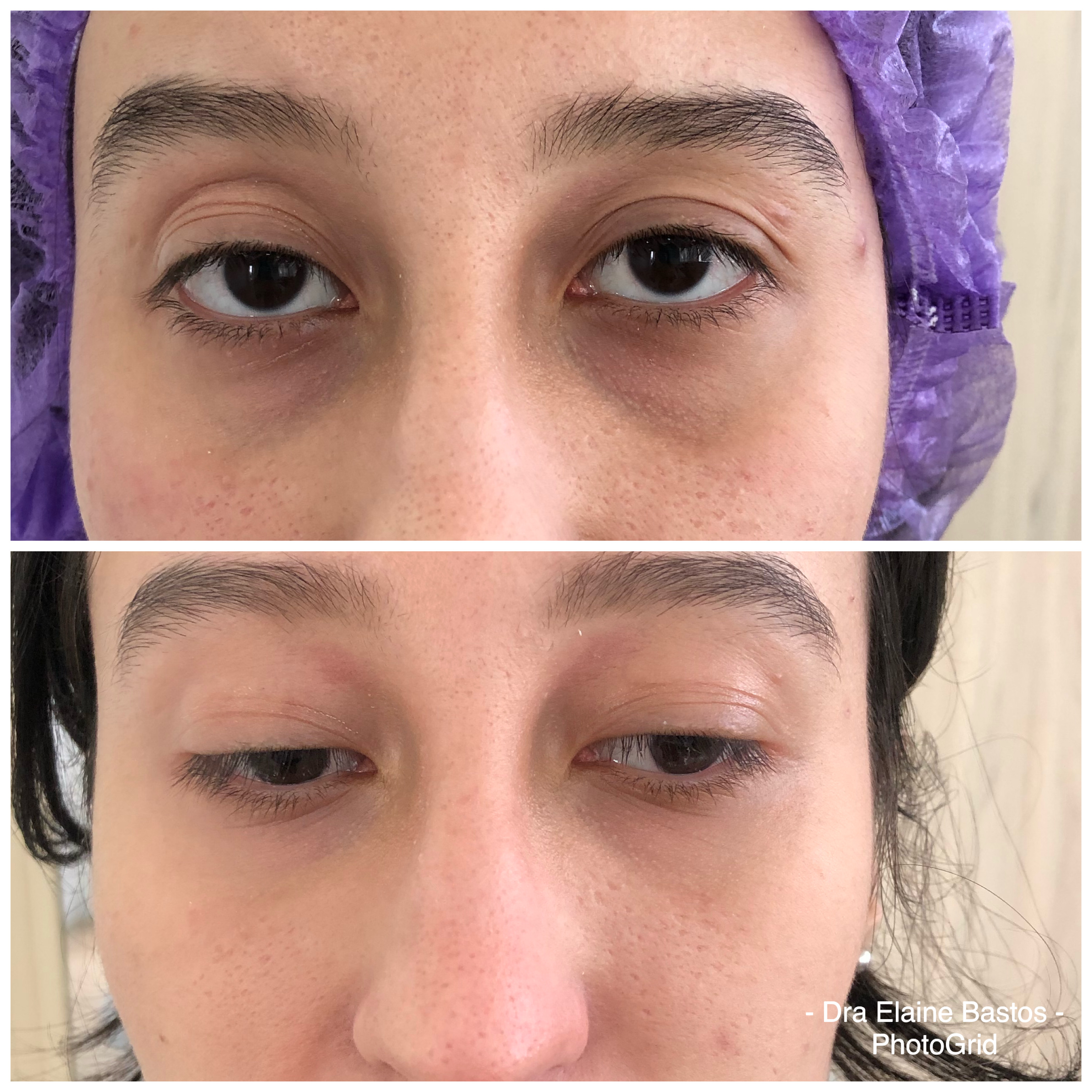 Antes e depois — Preenchimento de olheiras na Clínica Sensitivity, Osasco