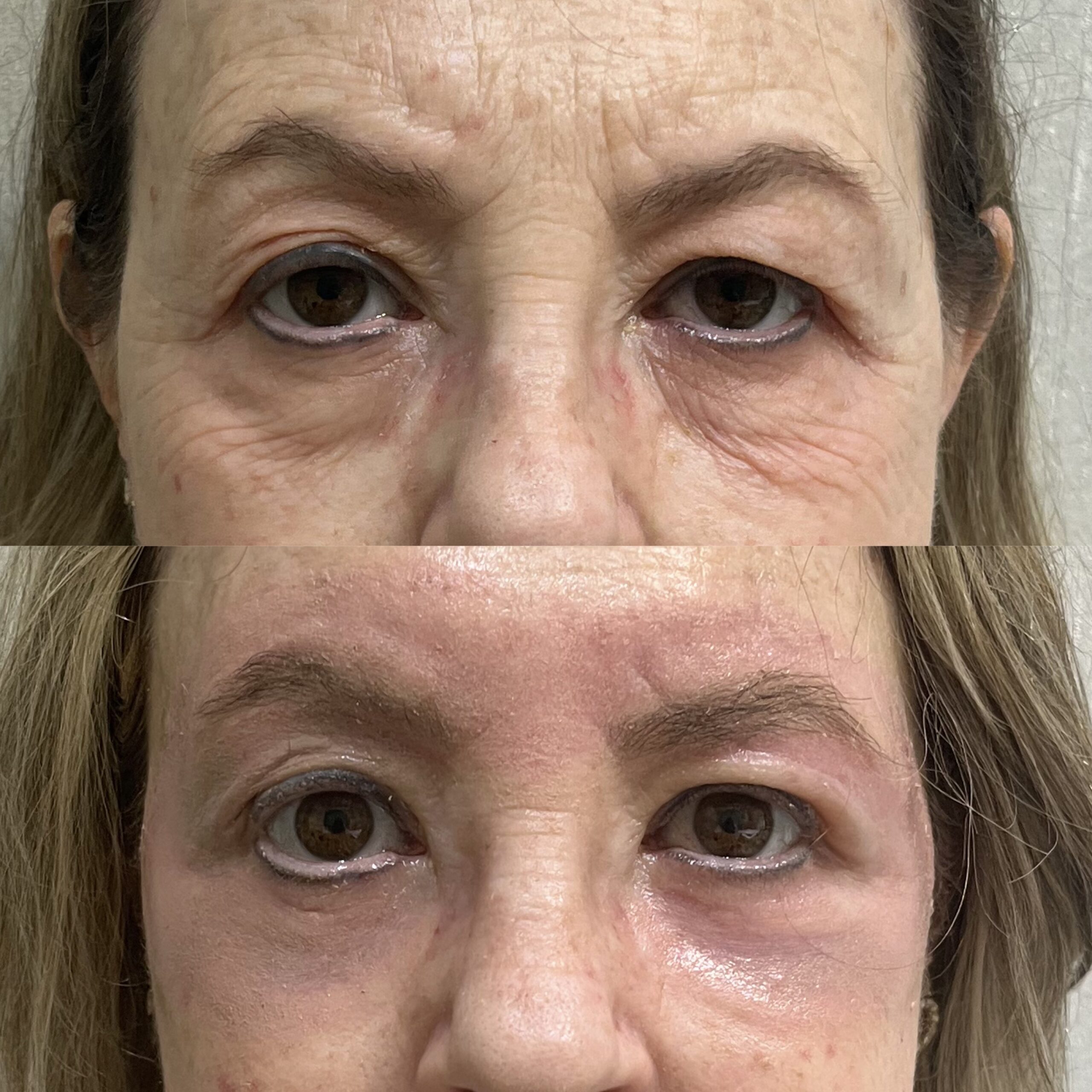 Antes e depois — Protocolo LineSkin — região dos olhos na Clínica Sensitivity, Osasco
