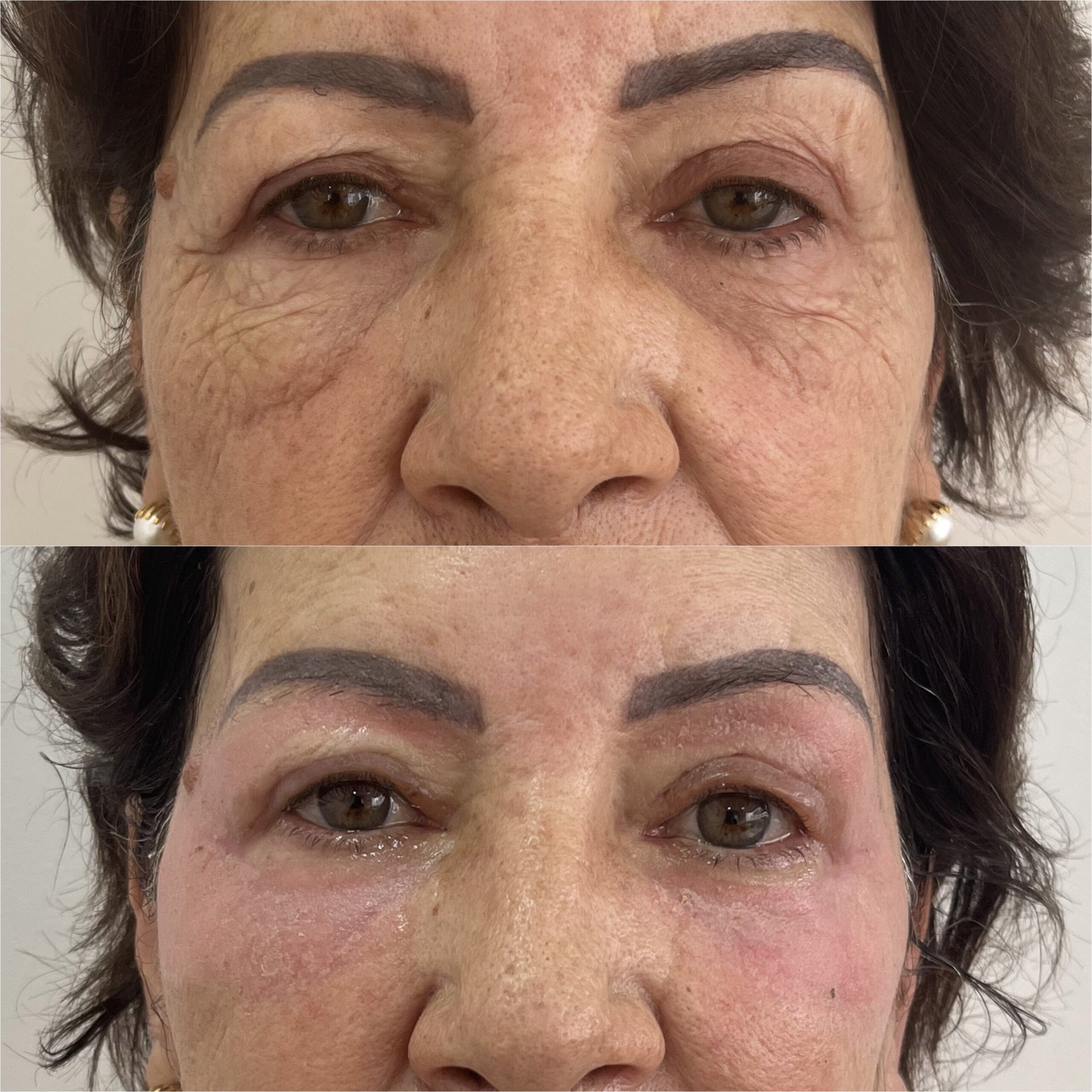Aplicação de bioestimulador de colágeno na Clínica Sensitivity, em Osasco