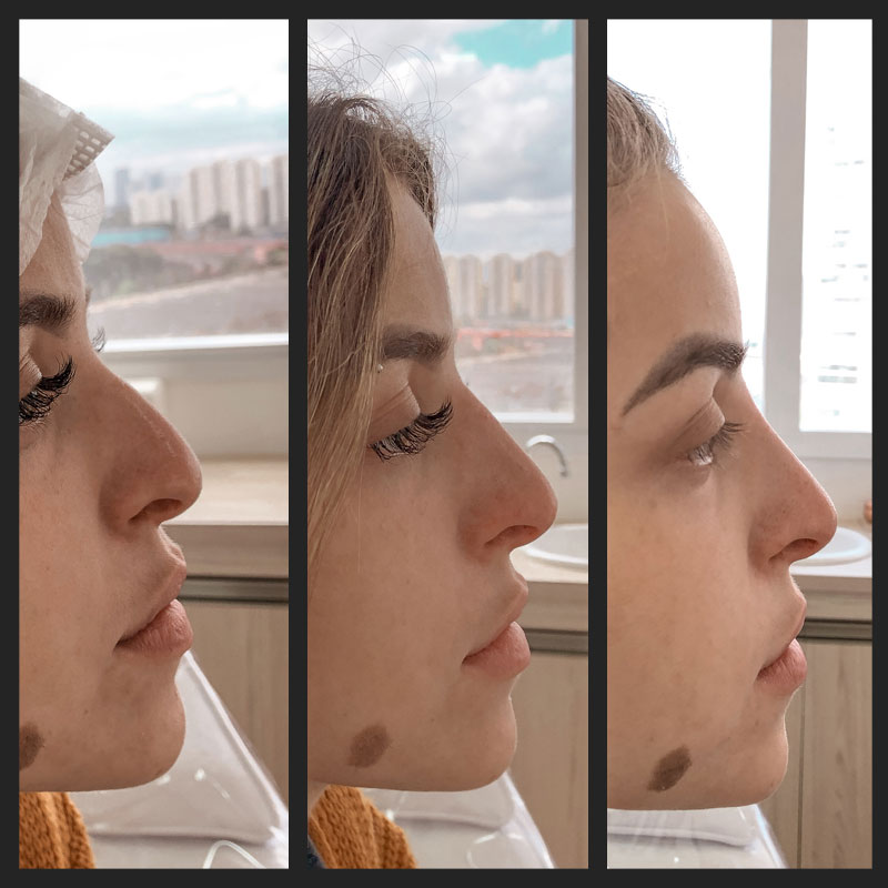 Antes e depois — Rinomodelação — perfil na Clínica Sensitivity, Osasco