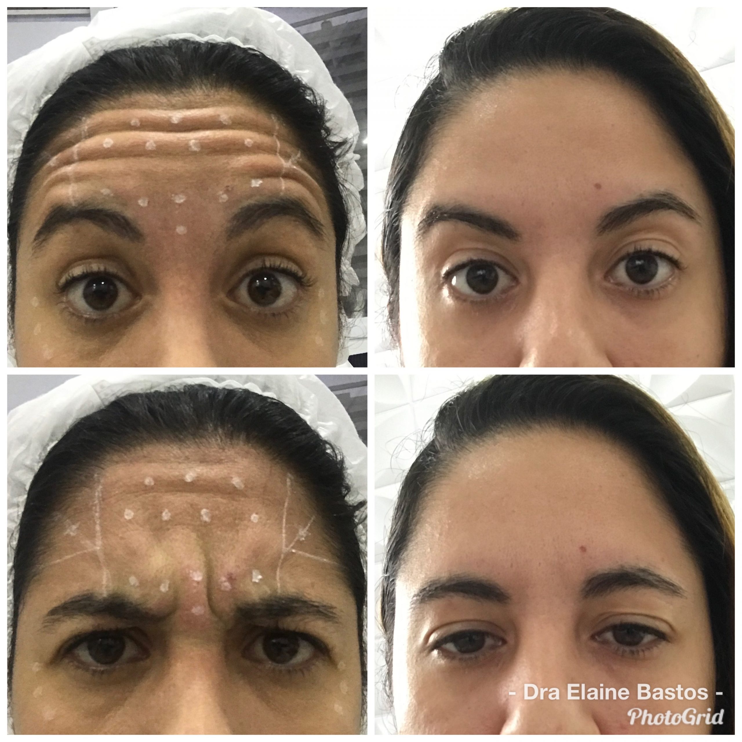Antes e depois — Botox — testa e glabela na Clínica Sensitivity, Osasco