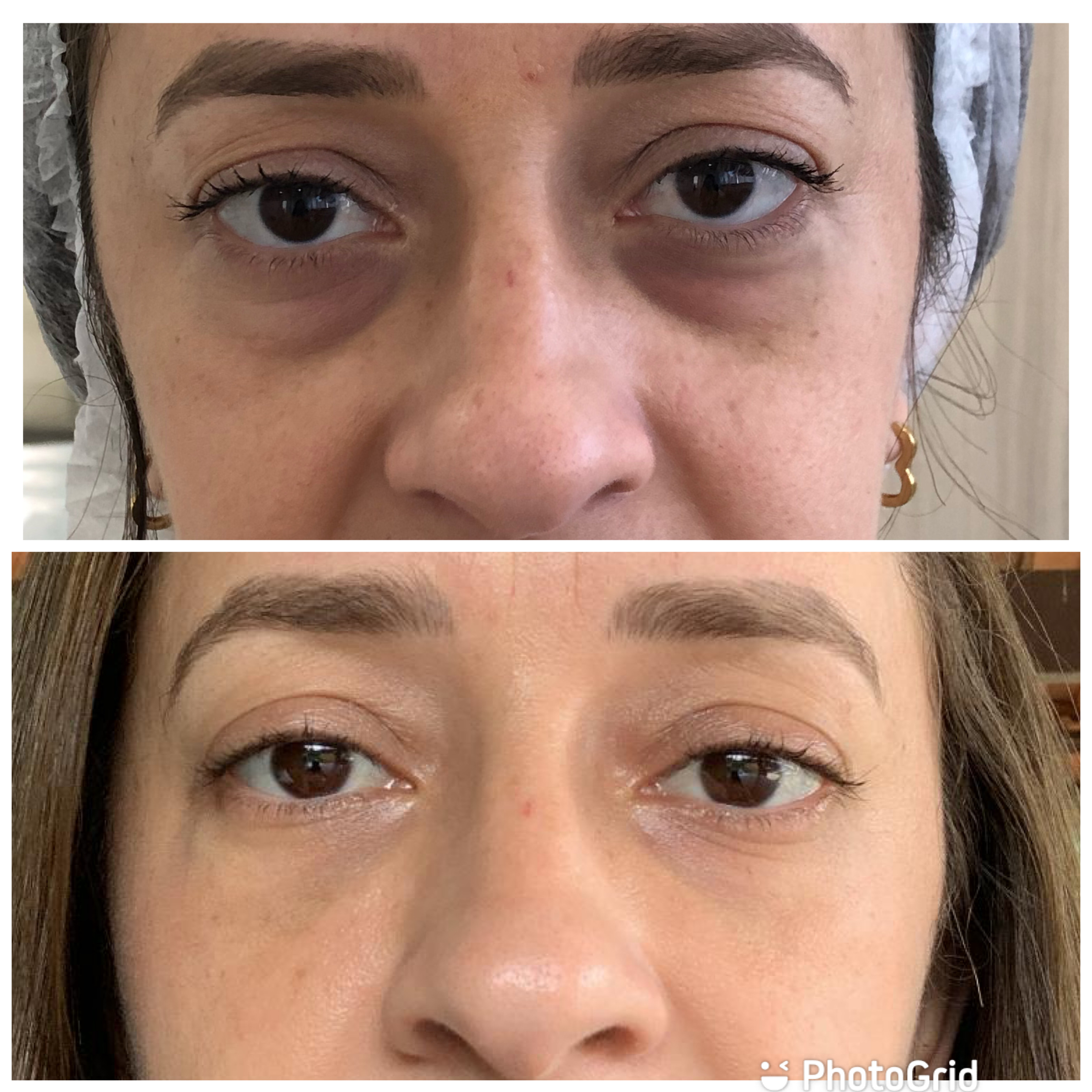 Antes e depois — Preenchimento de olheiras na Clínica Sensitivity, Osasco