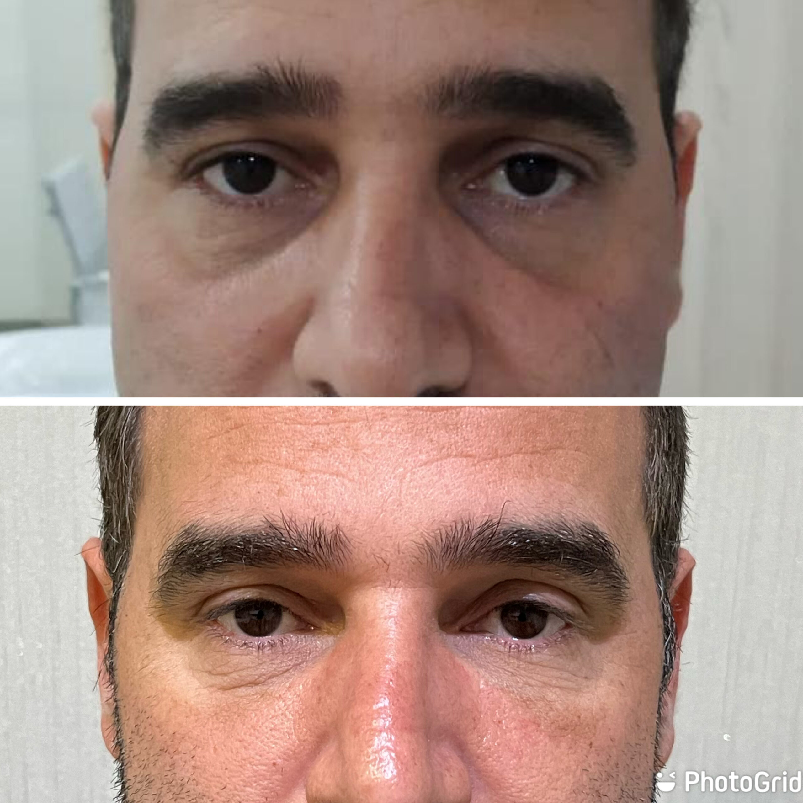 Antes e depois — Preenchimento de olheiras na Clínica Sensitivity, Osasco
