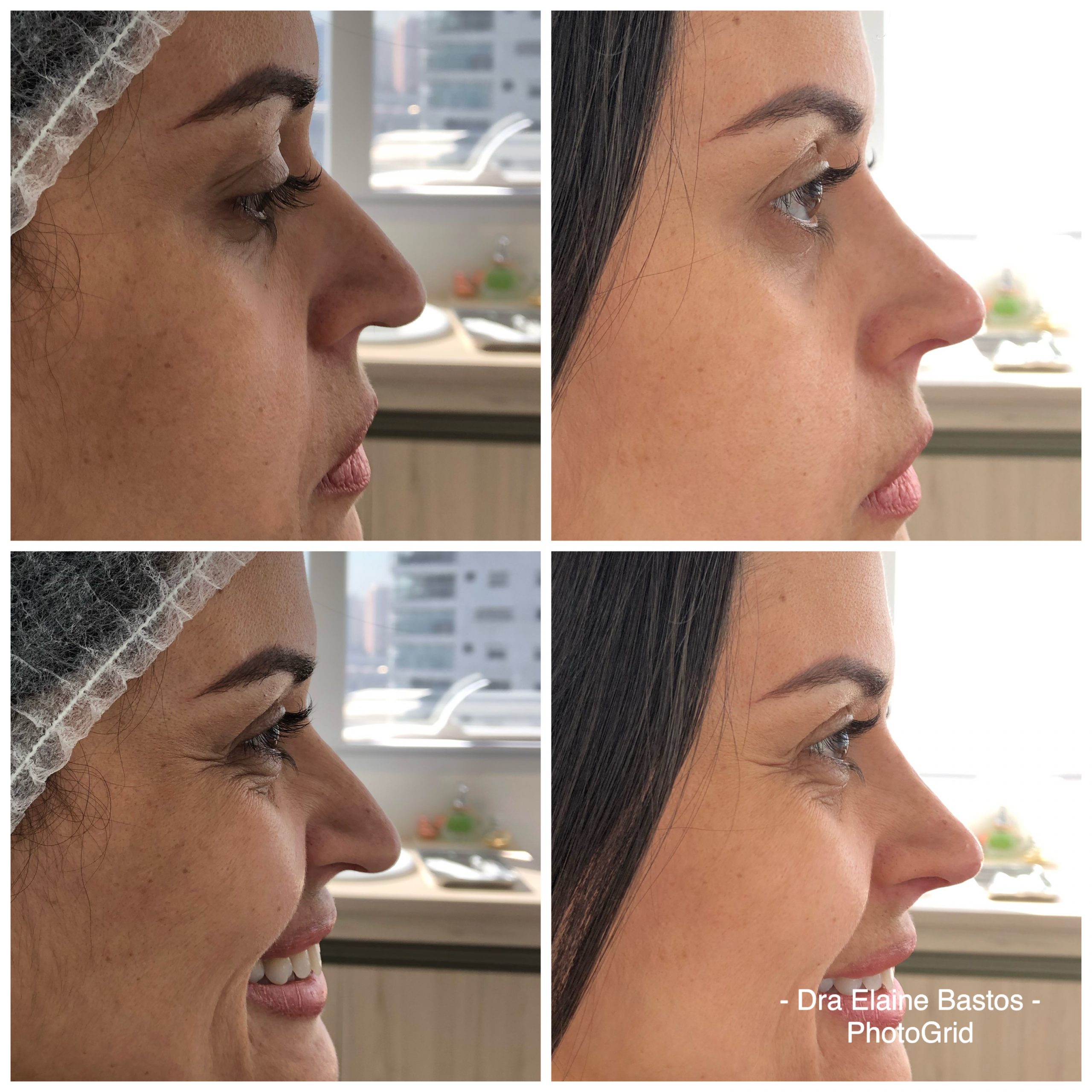 Antes e depois — Rinomodelação na Clínica Sensitivity, Osasco