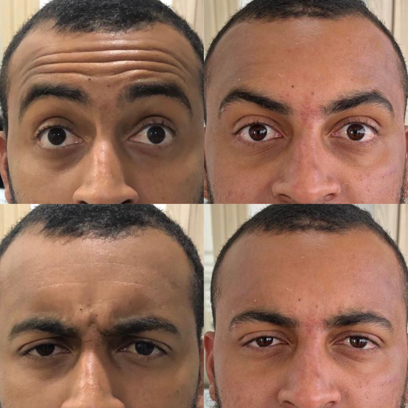 Antes e depois — Botox — testa (masculino) na Clínica Sensitivity, Osasco