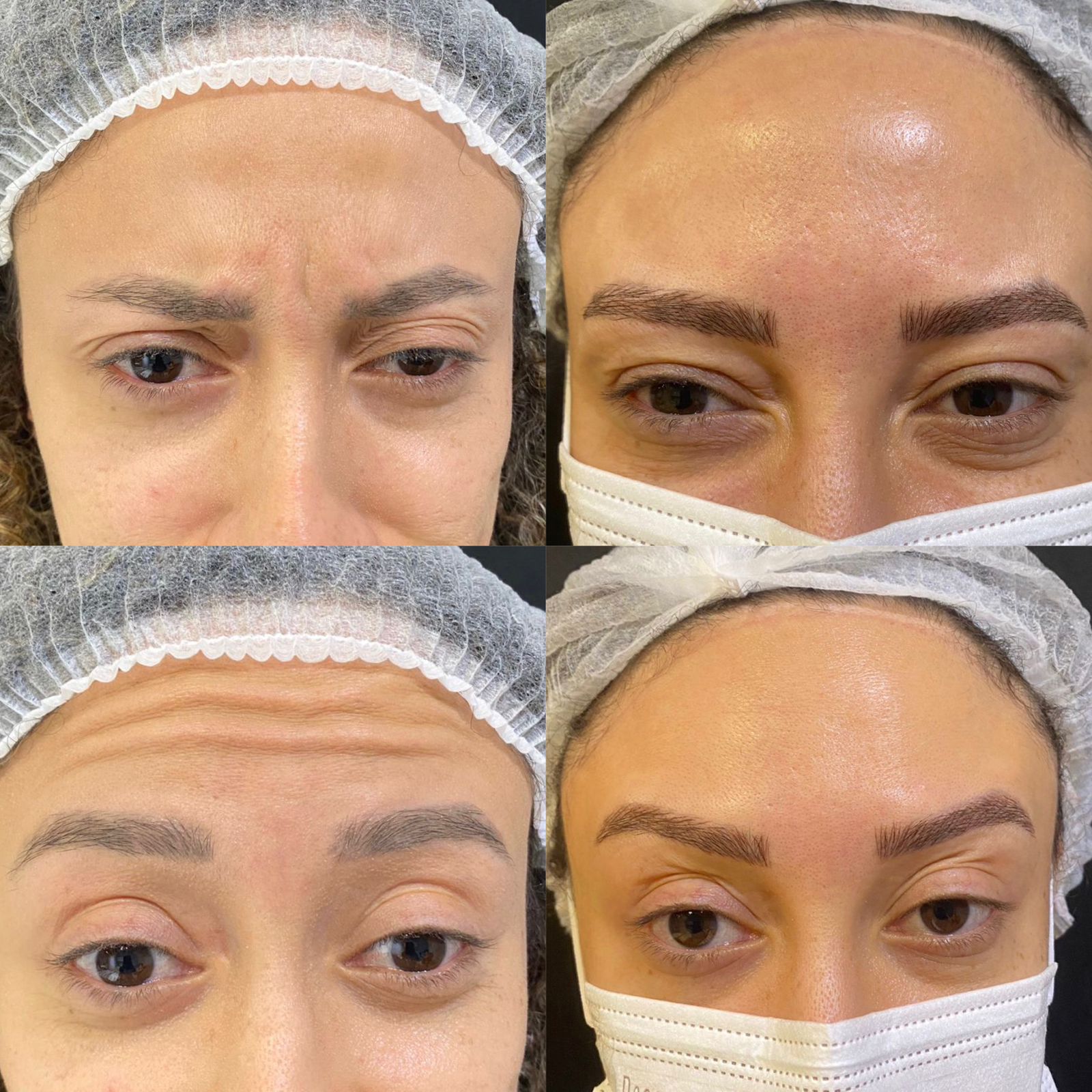 Antes e depois — Botox — linhas da testa na Clínica Sensitivity, Osasco