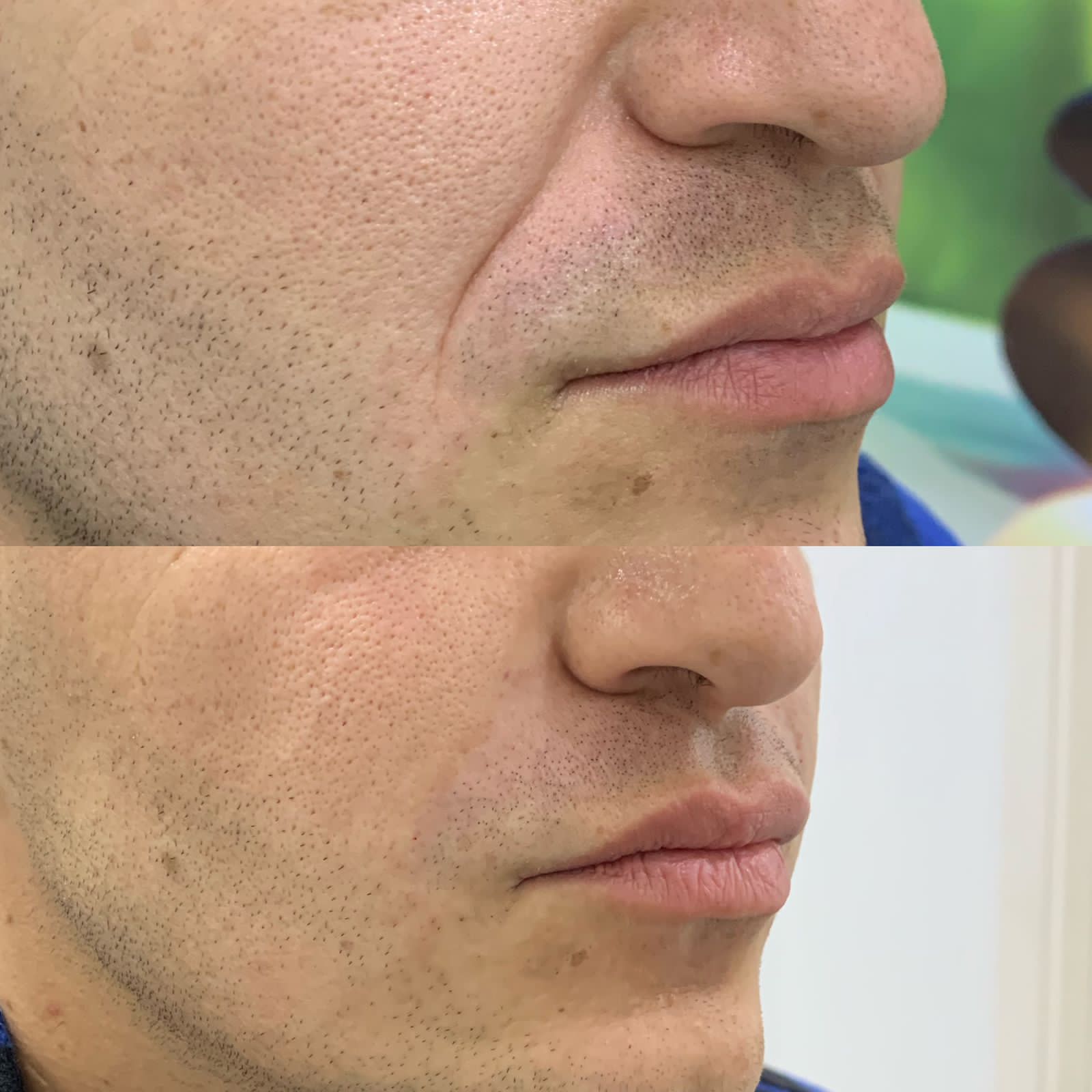 Antes e depois — Preenchimento — bigode chinês na Clínica Sensitivity, Osasco