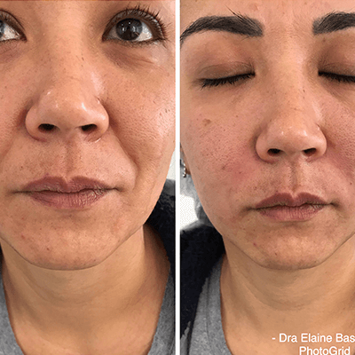 Antes e depois — Preenchimento — bigode chinês na Clínica Sensitivity, Osasco