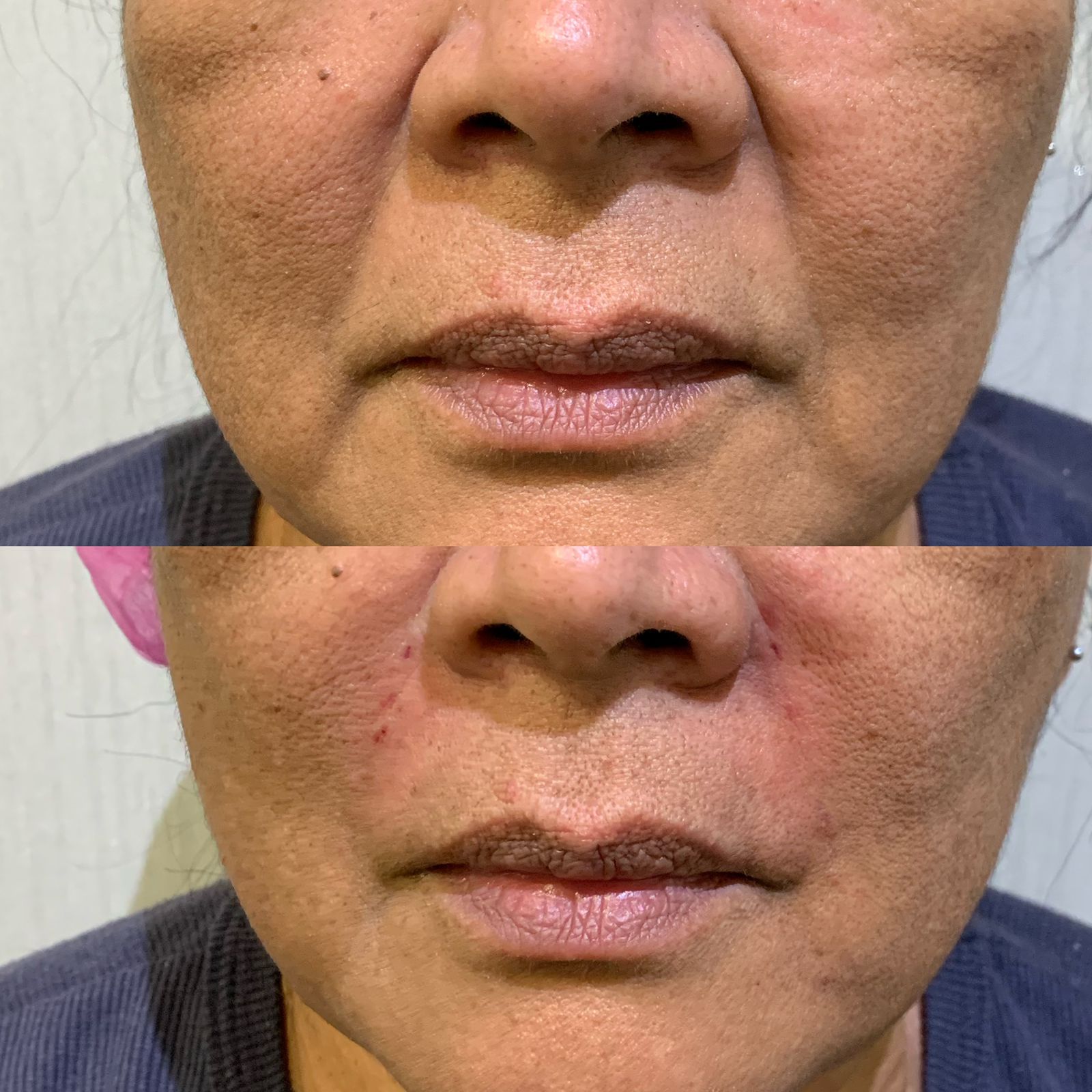 Antes e depois — Preenchimento — bigode chinês na Clínica Sensitivity, Osasco