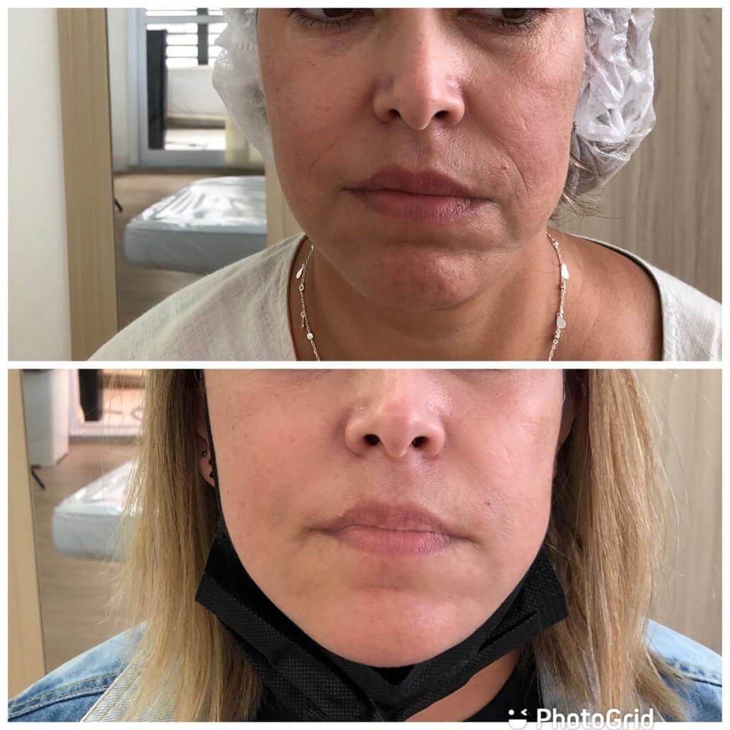 Antes e depois — Bioestimulador — firmeza na Clínica Sensitivity, Osasco
