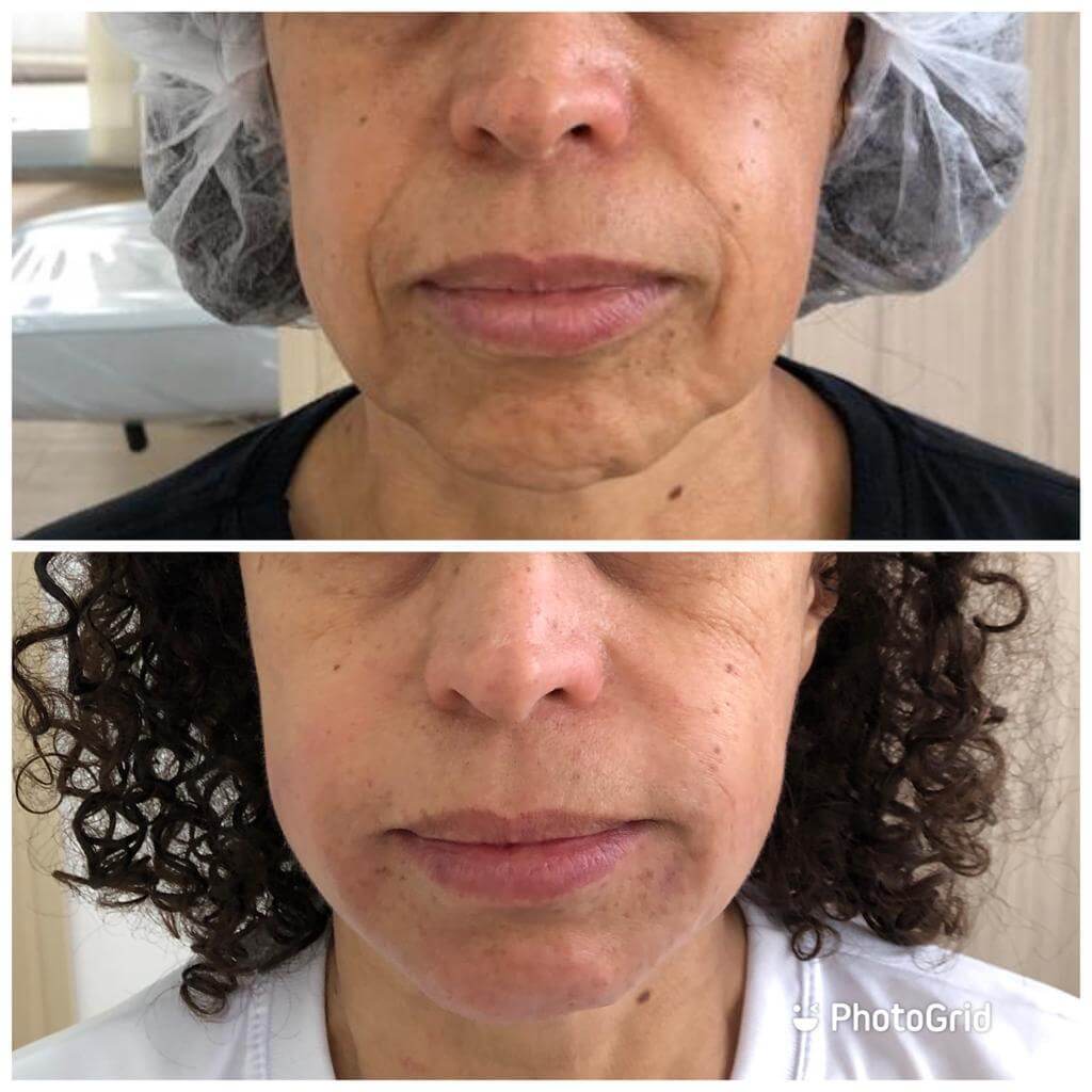 Antes e depois — Bioestimulador — colágeno na Clínica Sensitivity, Osasco