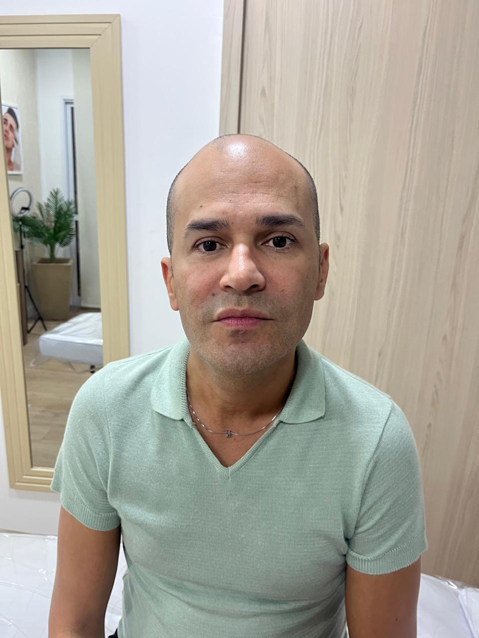Aplicação de toxina botulínica no rosto, na Clínica Sensitivity, em Osasco
