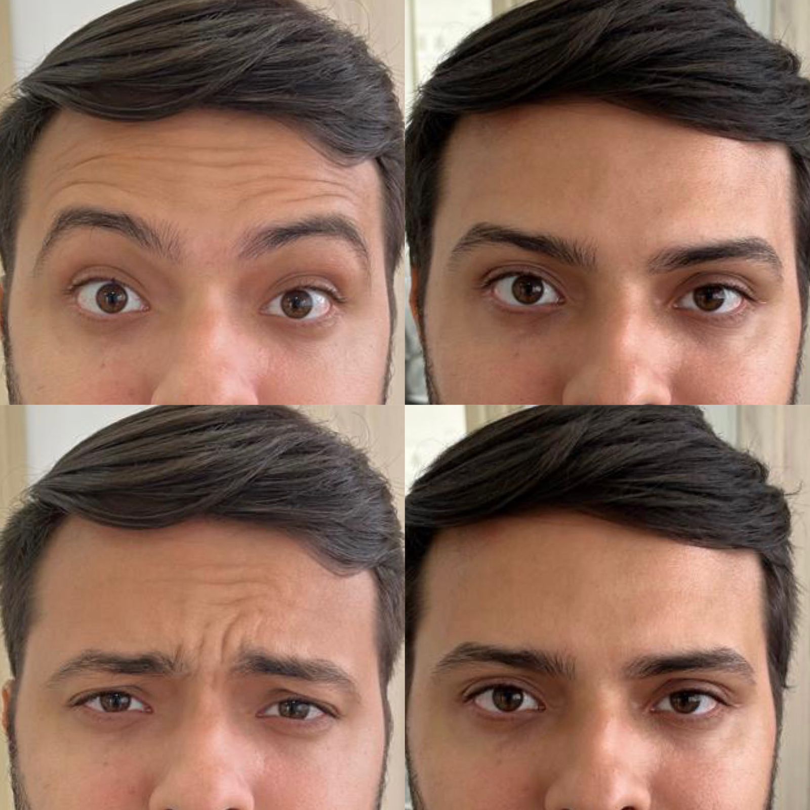 Antes e depois — Botox — antes e depois na Clínica Sensitivity, Osasco