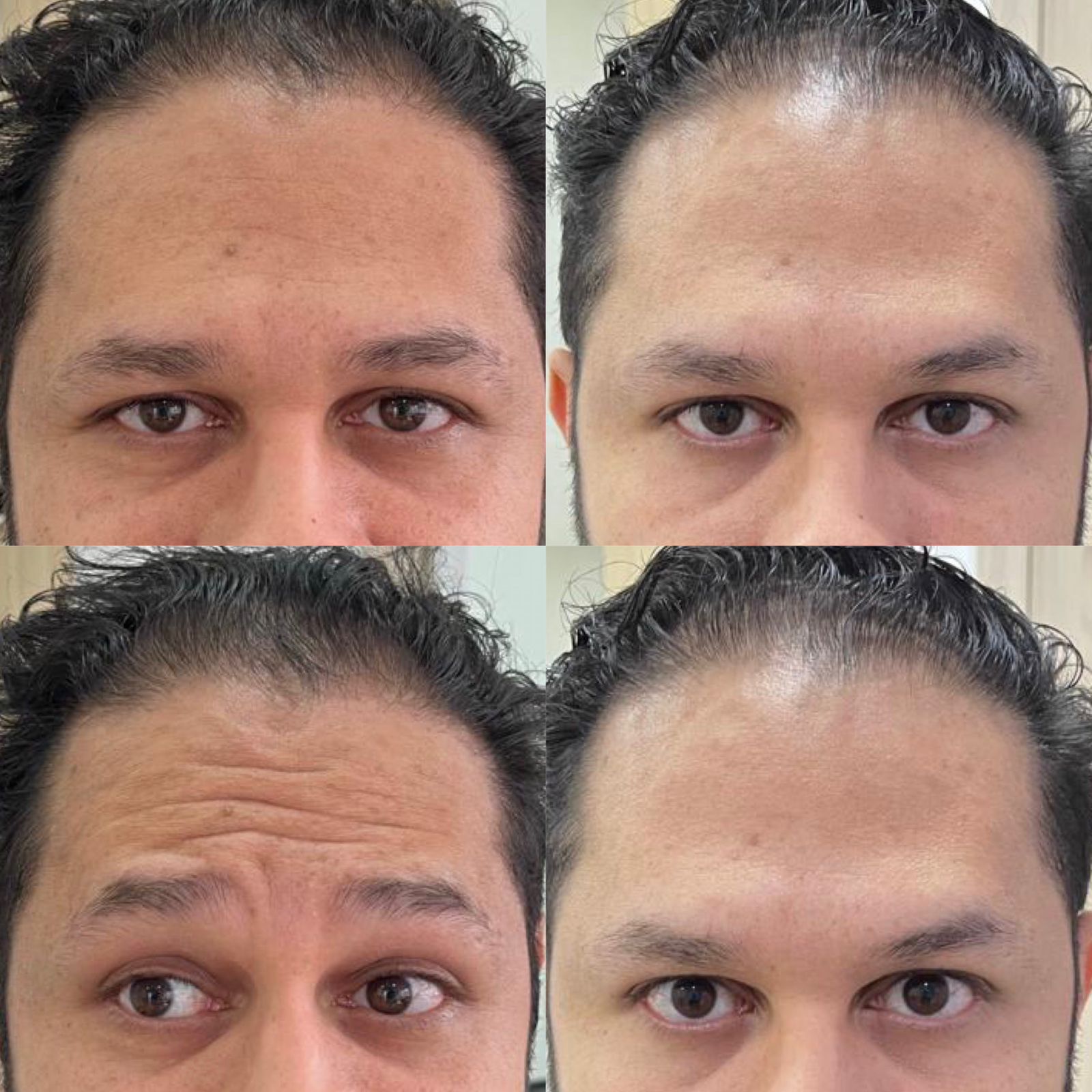 Antes e depois — Botox — antes e depois na Clínica Sensitivity, Osasco
