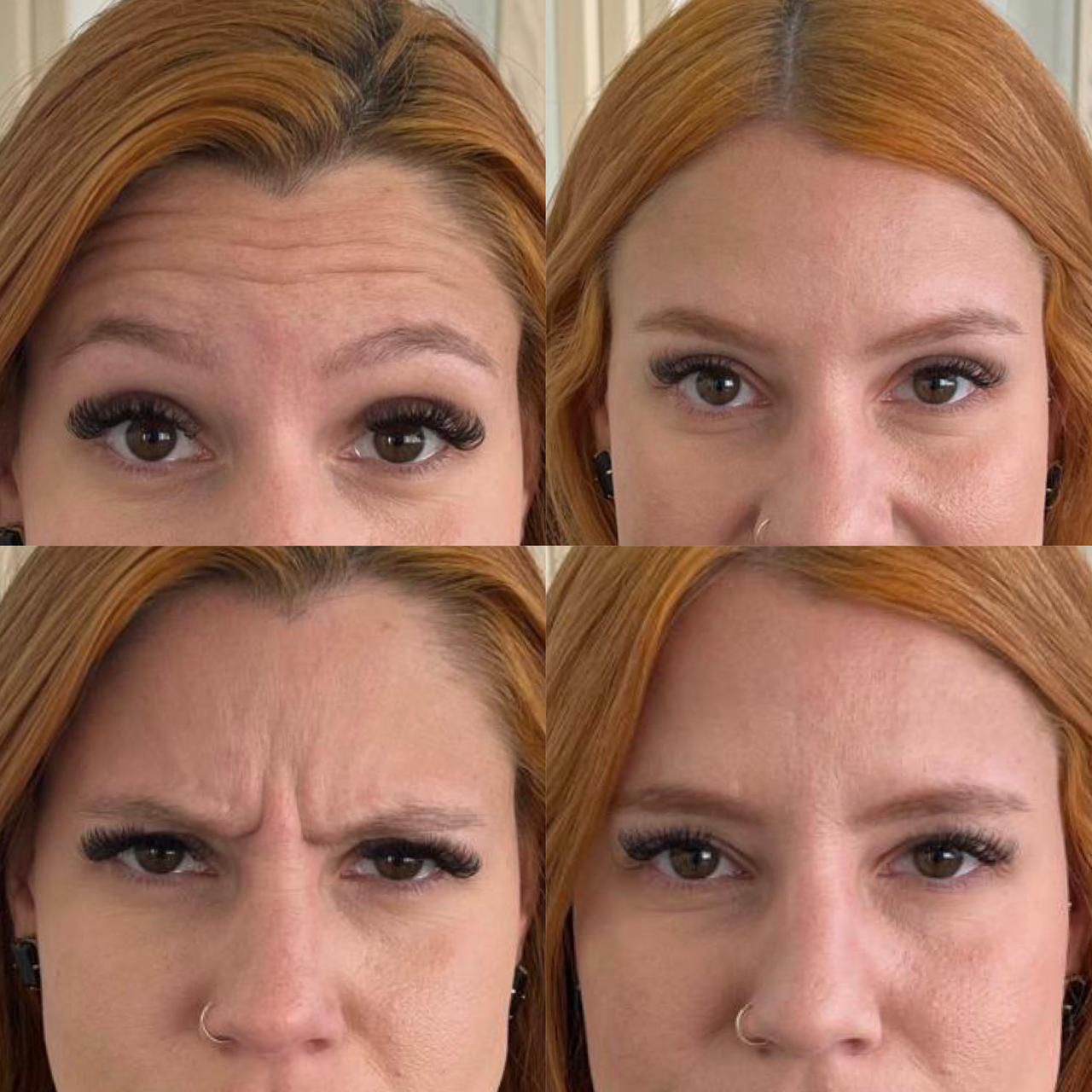 Antes e depois — Botox — linhas de expressão na Clínica Sensitivity, Osasco