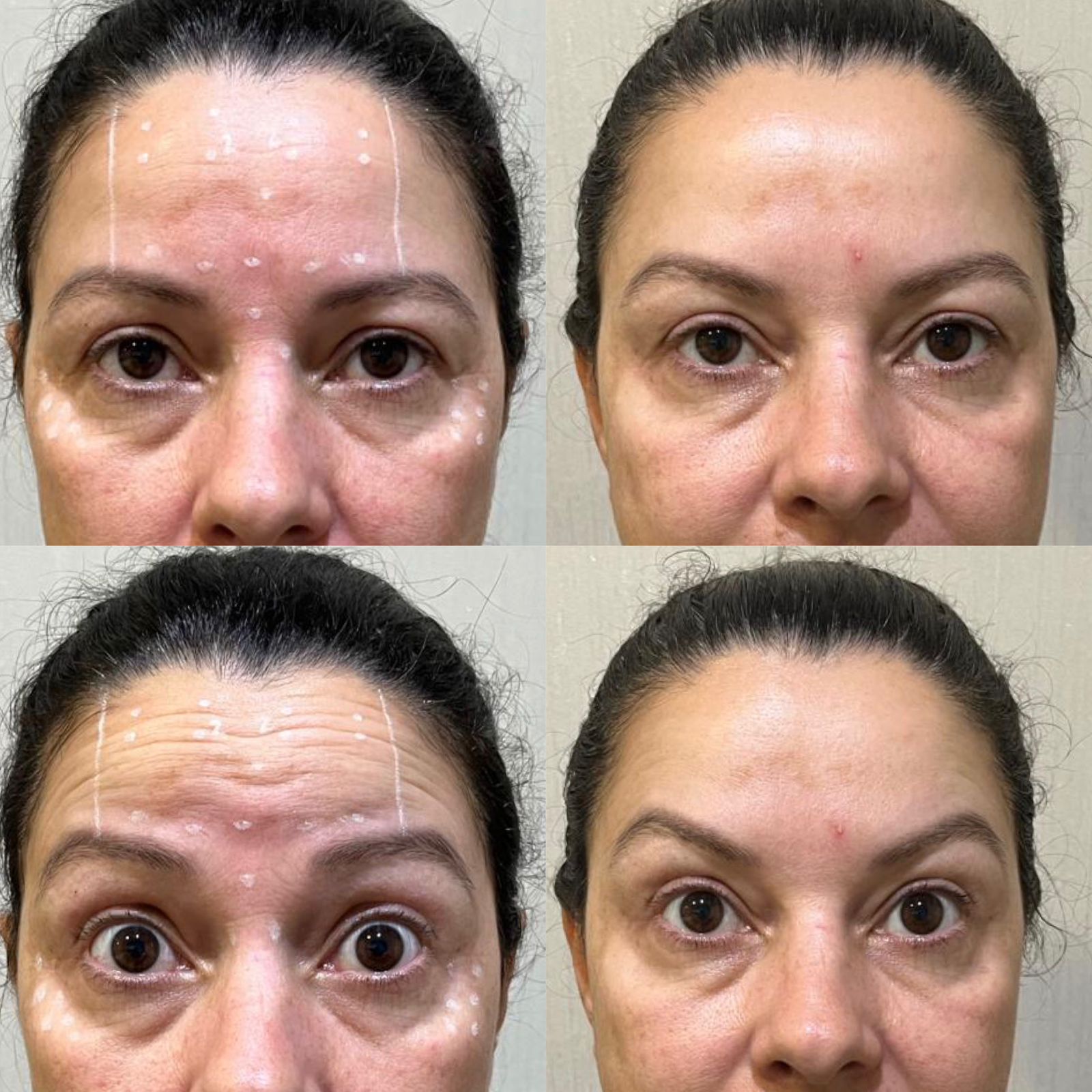 Antes e depois — Botox — linhas de expressão na Clínica Sensitivity, Osasco