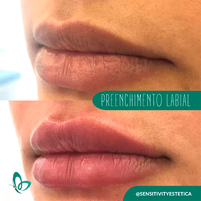 Antes e depois — Preenchimento labial na Clínica Sensitivity, Osasco