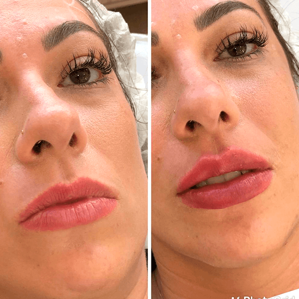 Antes e depois — Preenchimento labial na Clínica Sensitivity, Osasco