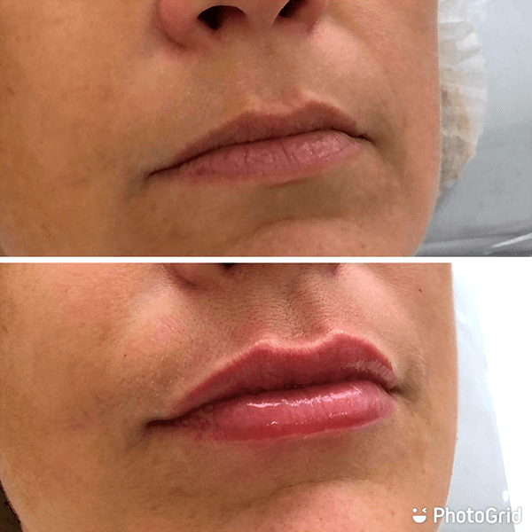 Antes e depois — Preenchimento labial na Clínica Sensitivity, Osasco