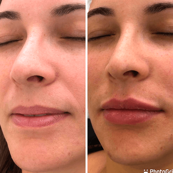Antes e depois — Preenchimento labial na Clínica Sensitivity, Osasco