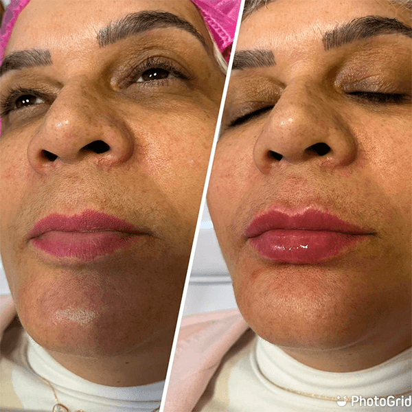 Antes e depois — Preenchimento labial na Clínica Sensitivity, Osasco