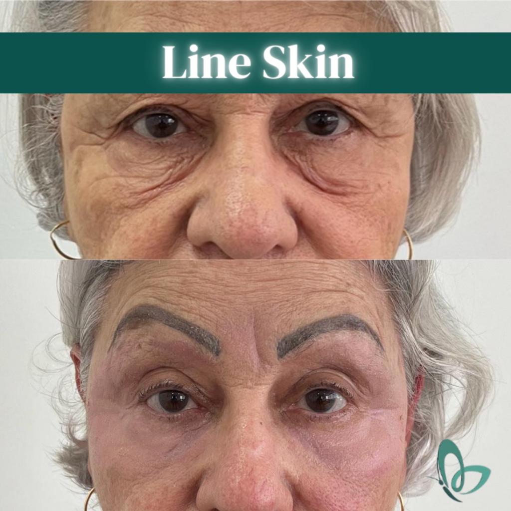 Antes e depois — Protocolo LineSkin — rejuvenescimento do olhar na Clínica Sensitivity, Osasco