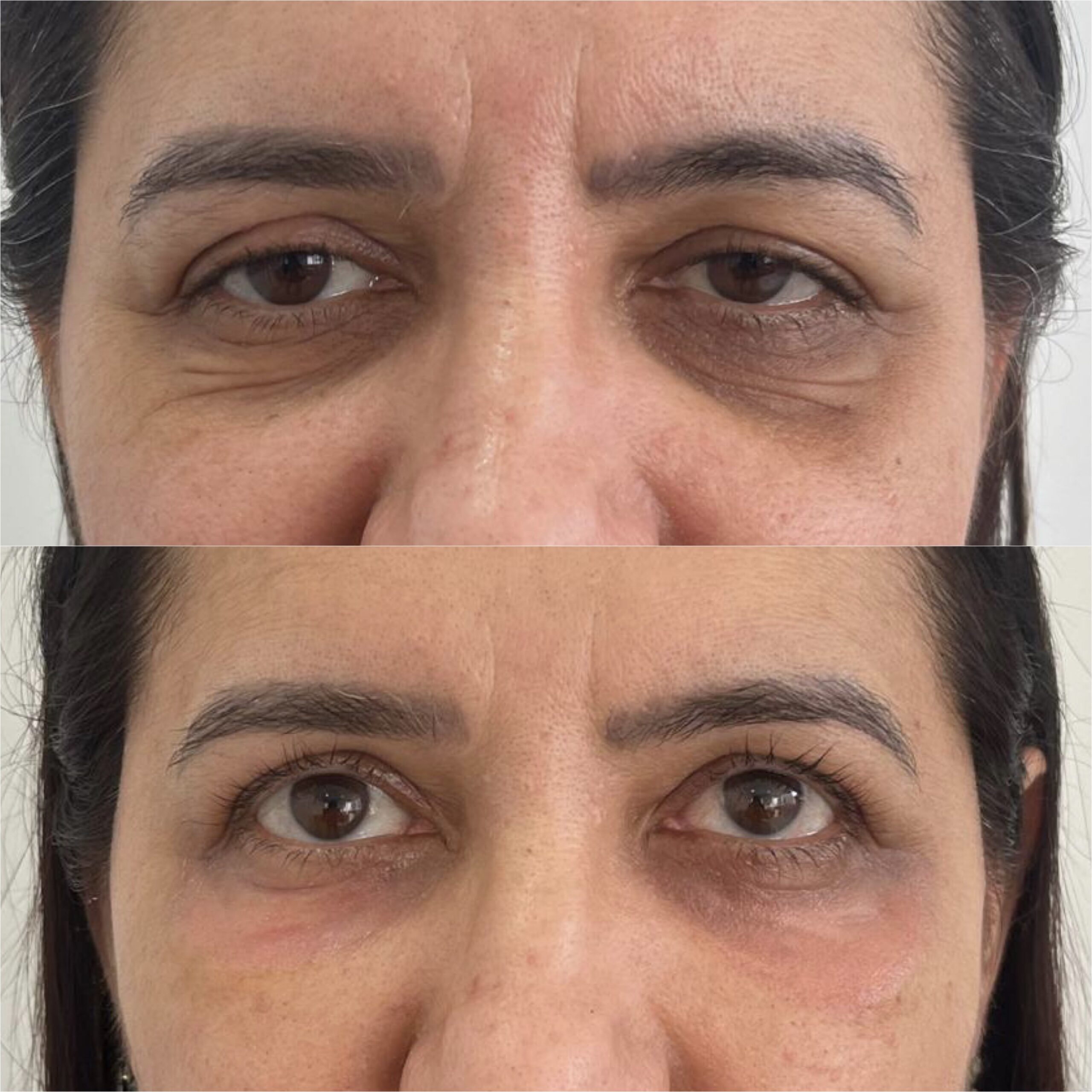 Antes e depois — Protocolo LineSkin — região dos olhos na Clínica Sensitivity, Osasco