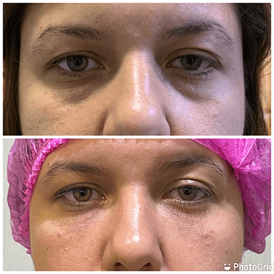 Antes e depois — Preenchimento de olheiras na Clínica Sensitivity, Osasco