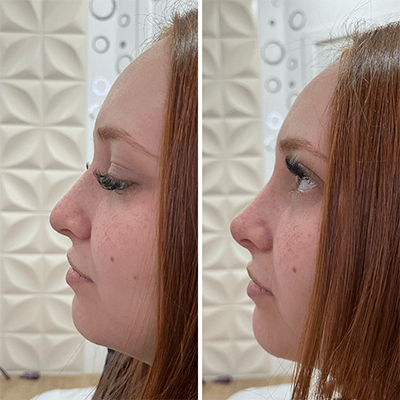 Antes e depois — Rinomodelação — antes e depois na Clínica Sensitivity, Osasco