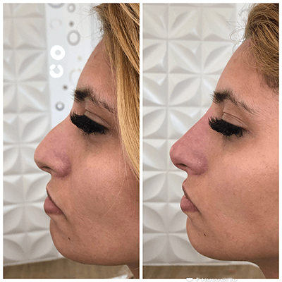 Antes e depois — Rinomodelação — antes e depois na Clínica Sensitivity, Osasco