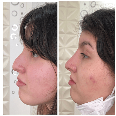 Antes e depois — Rinomodelação — antes e depois na Clínica Sensitivity, Osasco