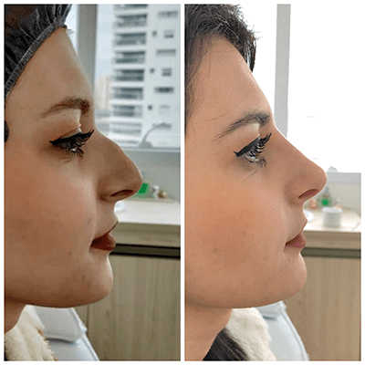 Antes e depois — Rinomodelação — antes e depois na Clínica Sensitivity, Osasco