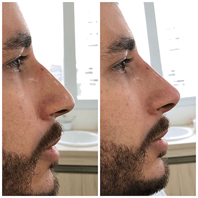 Antes e depois — Rinomodelação — antes e depois na Clínica Sensitivity, Osasco