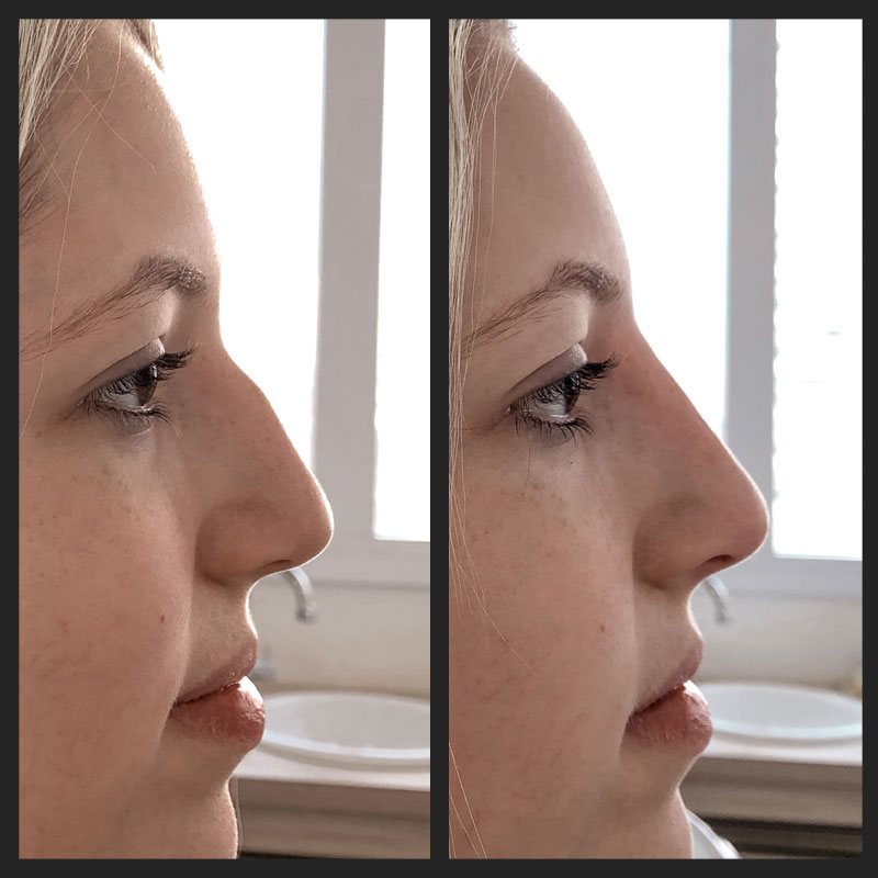 Antes e depois — Rinomodelação — perfil na Clínica Sensitivity, Osasco