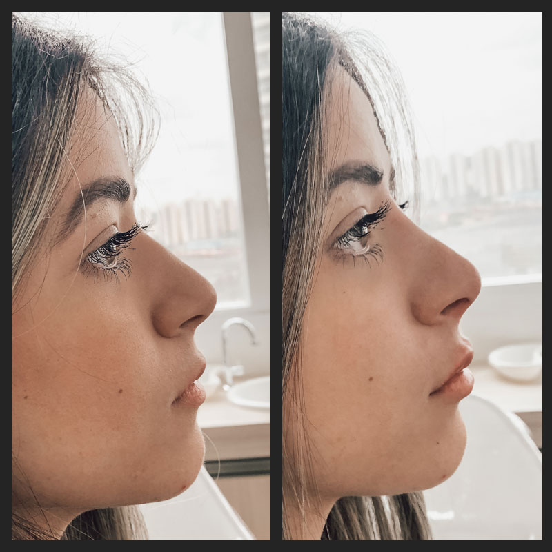Antes e depois — Rinomodelação — antes e depois na Clínica Sensitivity, Osasco