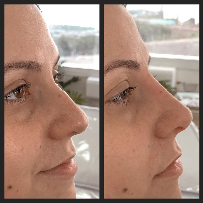 Antes e depois — Rinomodelação — antes e depois na Clínica Sensitivity, Osasco