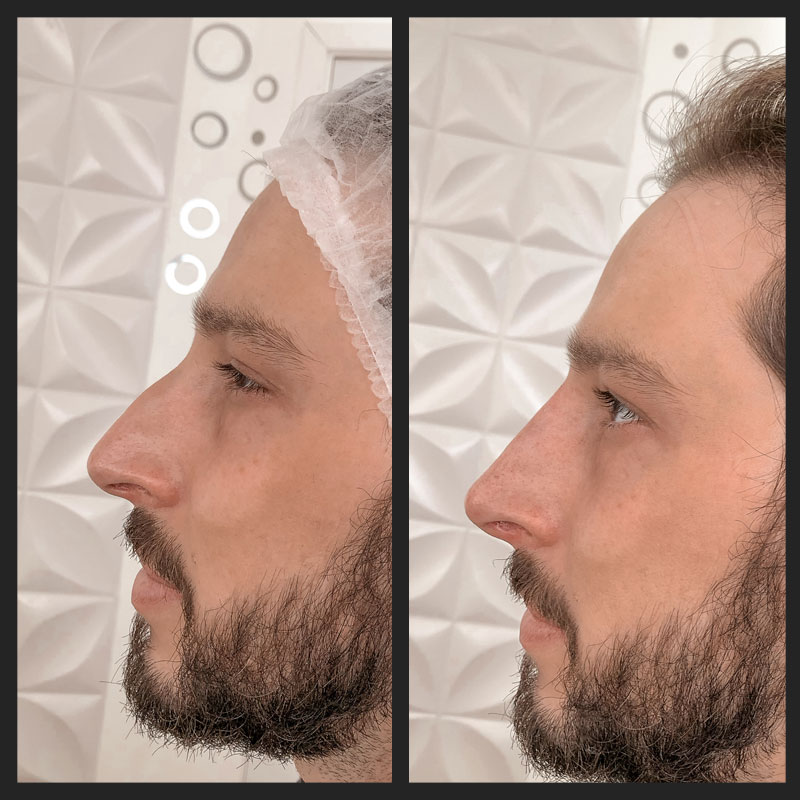 Antes e depois — Rinomodelação — antes e depois na Clínica Sensitivity, Osasco