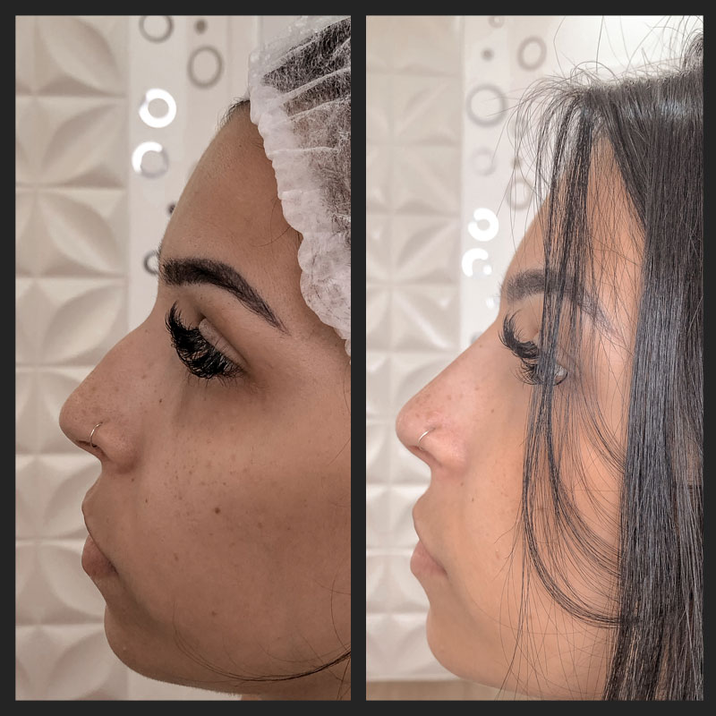 Antes e depois — Rinomodelação — antes e depois na Clínica Sensitivity, Osasco