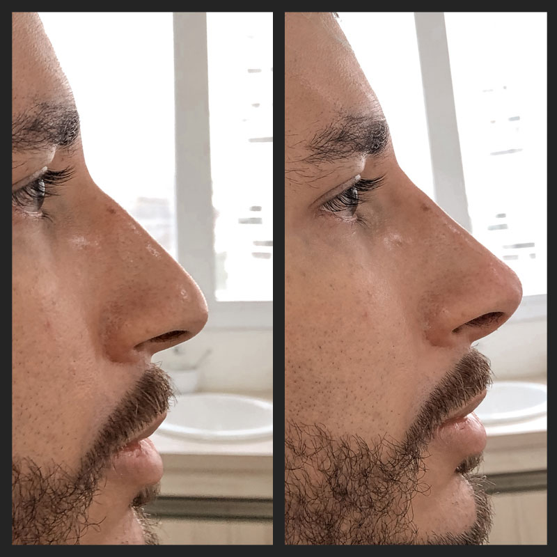 Antes e depois — Rinomodelação — antes e depois na Clínica Sensitivity, Osasco