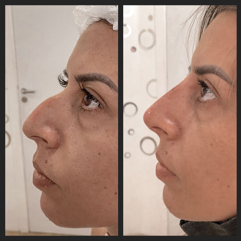 Antes e depois — Rinomodelação — antes e depois na Clínica Sensitivity, Osasco