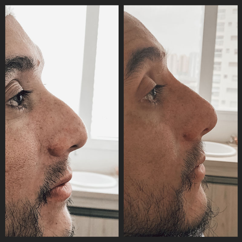 Antes e depois — Rinomodelação — antes e depois na Clínica Sensitivity, Osasco